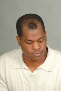 לפני מילוי לשיער דליל