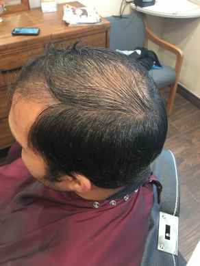 לפני מילוי שיער דליל במיוחד