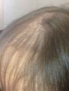 לפני עיבוי שיער