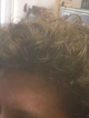 אחרי מילוי שיער