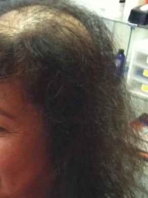 לפני השלמת קרחת במרכז הקרקפת