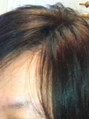 אחרי מילוי שיער דליל במיוחד