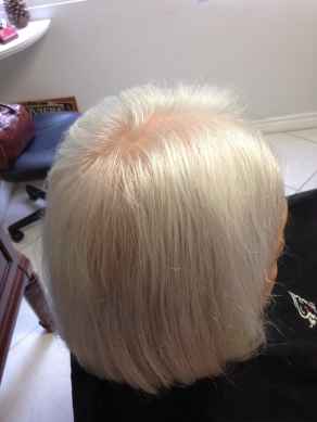 לפני-מילוי-והשלמת-שיער